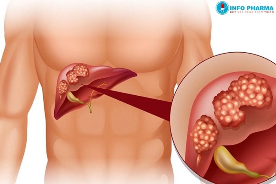 người nên sử dụng thực phẩm bảo vệ gan